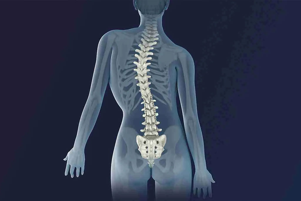 Scoliosis
